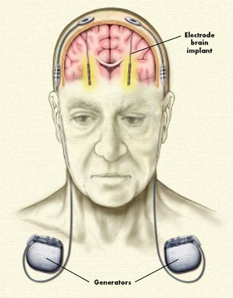 Deep brain stimulation - Brown University
