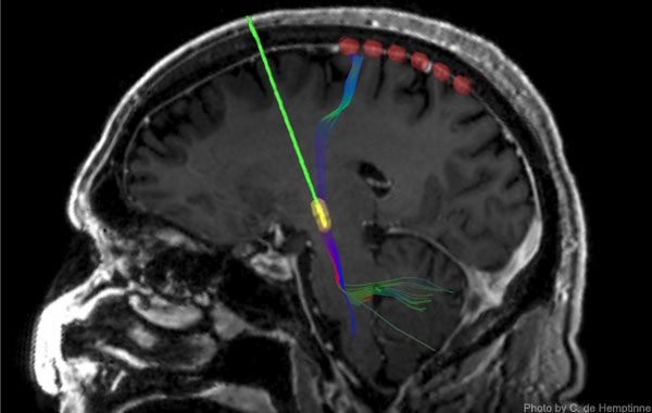 RM de donde se aprecia la actividad cortical y un electrodo de estimulación cerebral profunda (verde con punta amarilla). C. DE HEMOTINNE - ABC